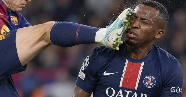 Willian Pacho recibió una patada en la cabeza ante Barcelona y terminó con el rostro marcado